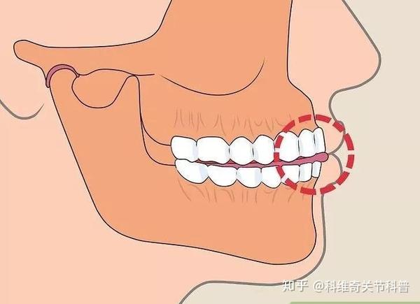 2.咀嚼肌的自我按摩放松