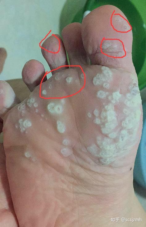 历时半年,我的跖疣终于被治好了(有图慎入)
