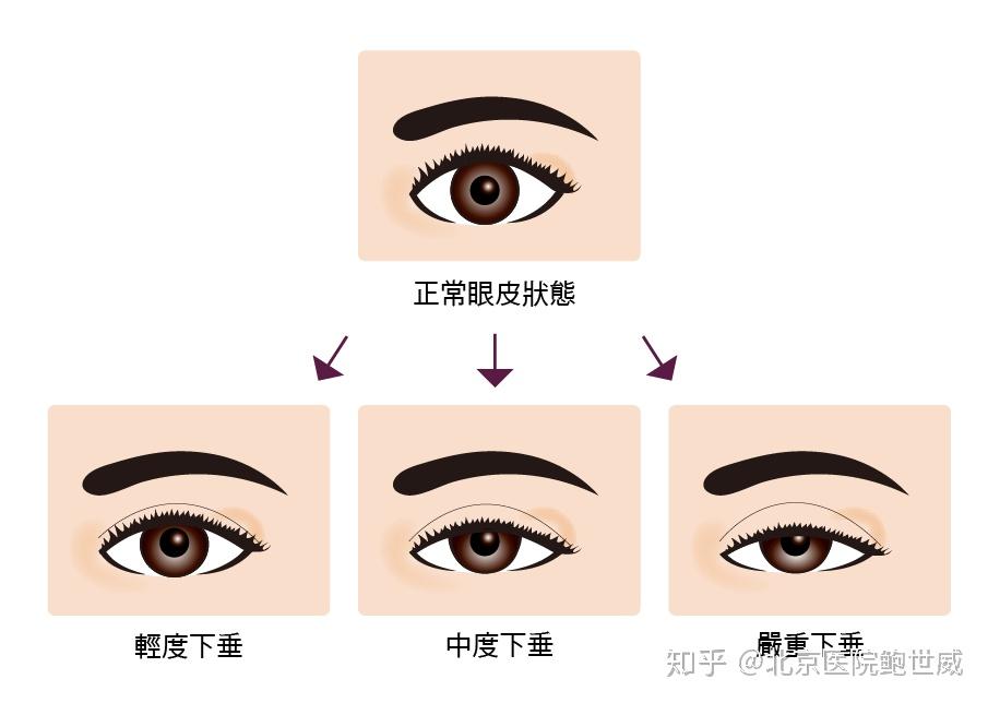 上睑下垂是以上眼皮下缘遮盖瞳孔的多少来区分严重程度,一般分为三个