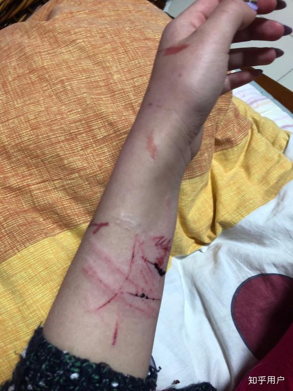 抑郁症患者自残是变态的行为吗?