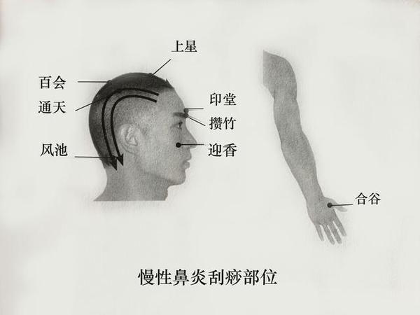 慢性鼻炎的刮痧部位 头颈部 印堂,迎香,百会,攒竹,通天,上星,风