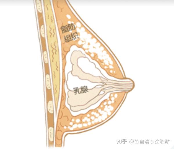 常见的术后并发症有 脂肪钙化,液化甚至坏死产生结节.