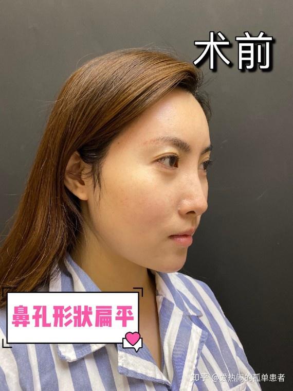 北京亲妈鼻,自然直鼻测评