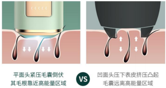 长远来看什么样的脱毛方法最安全效果最好