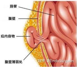 修补方法可以关注本公众号的图解腹股沟疝手术方式的相关内容