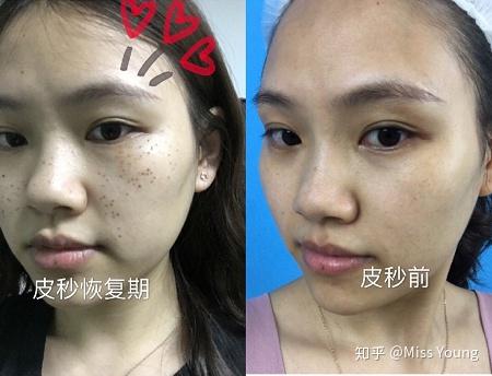 我皮秒前,恢复期,和皮秒后的照片给大家再看下