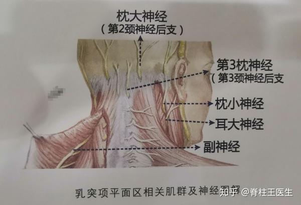 冲击波治疗《颈原型头痛,颈痛,后枕痛,顽固性颈部肌筋膜炎》新思路