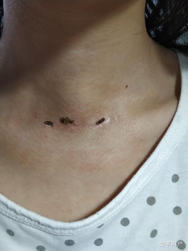 做过甲状腺结节切除手术后一年(还未满一年)怎样抚平脖颈上的疤痕