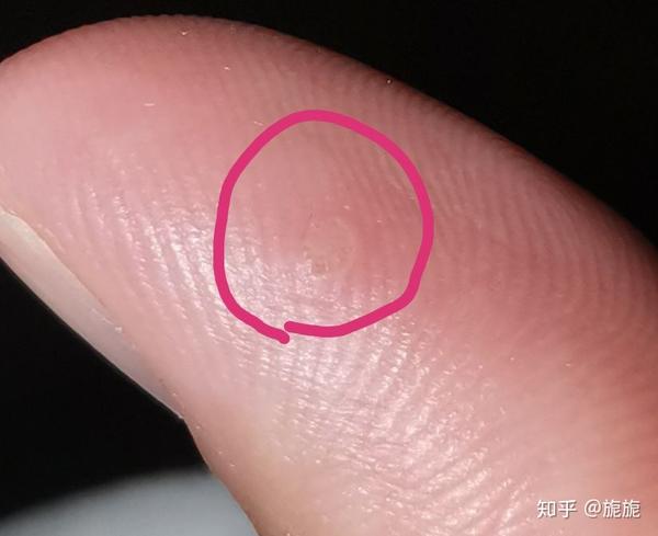 长在大拇指指腹上剪掉过几天又会长出来,摸起来硬硬的感觉像个疙瘩