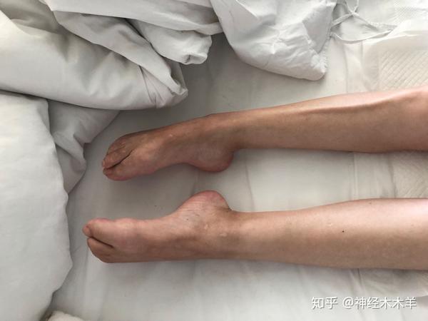 昏迷时间越长预后越不佳;(长时间昏迷,下肢呈痉挛性瘫痪,足下垂明显