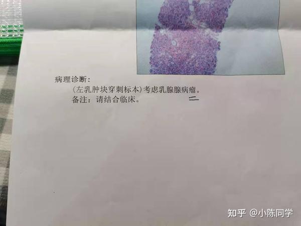 乳腺结节4a我的心路历程