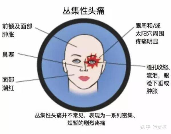 很常见的头痛却迟迟找不到源头最后结果出乎意料