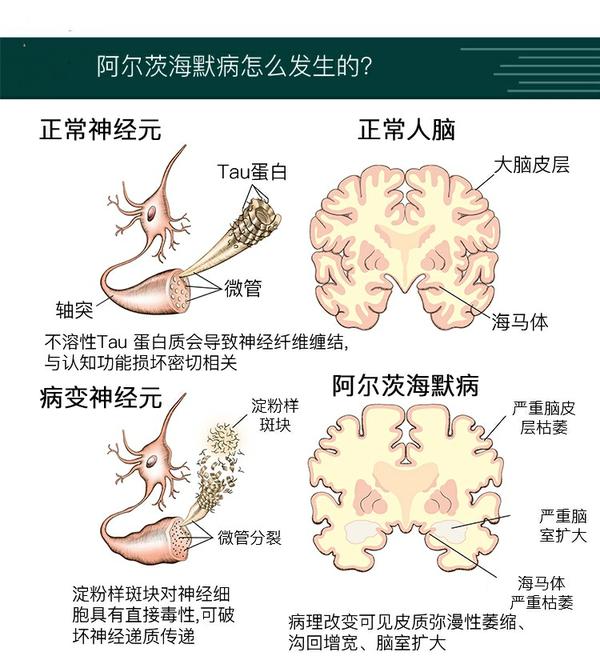 如何预防阿尔茨海默病老年痴呆