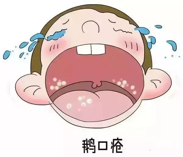 新生宝宝两侧脸颊会隆起脂肪垫,俗称螳螂嘴.