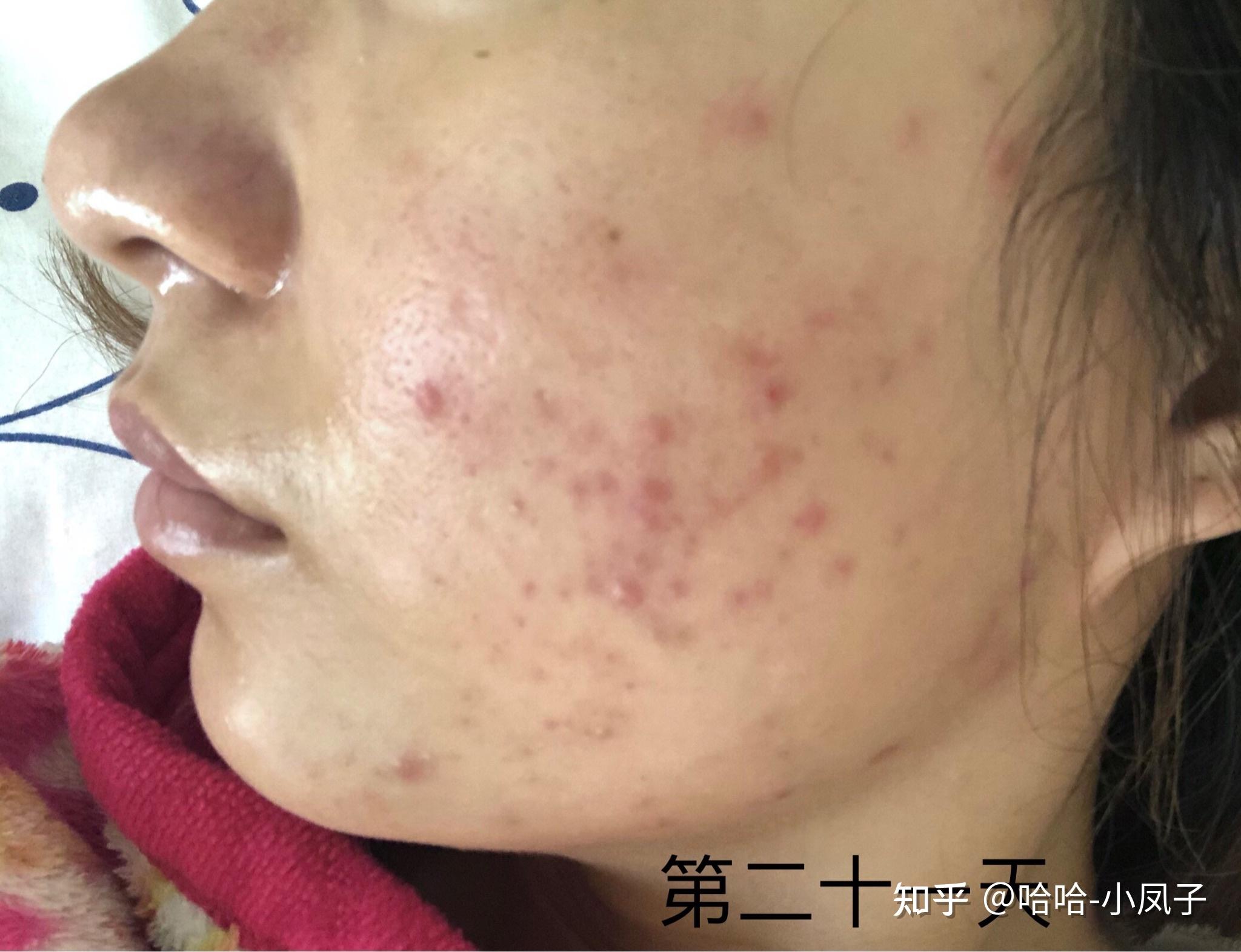 痘痘肌战痘记录