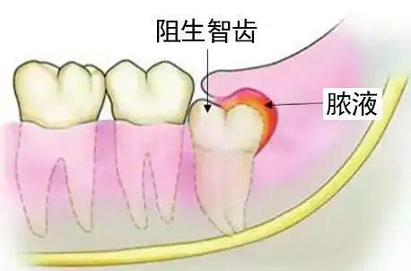 智齿,医生口中的第三磨牙,阻生齿,患者口中的立事牙,是口腔中最后一颗