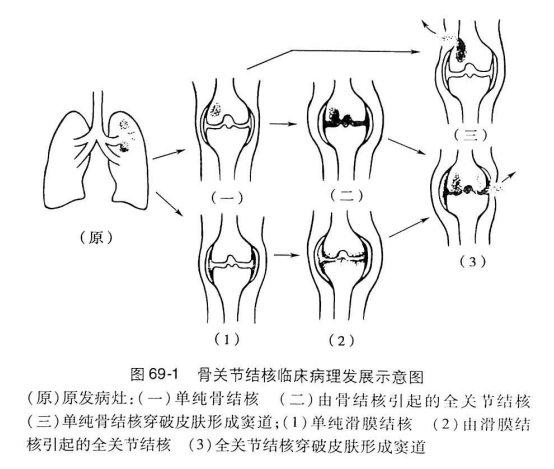 单纯性滑膜结核或单纯性骨结核→全关节结核→窦道或瘘管→继发感染