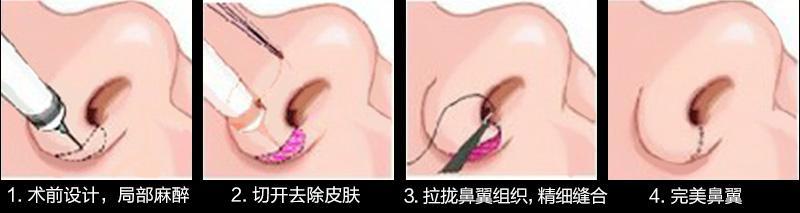 鼻翼缩小内切好还是外切好附干货上海隆鼻医生攻略