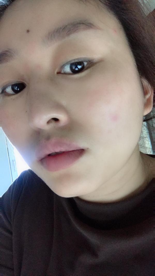 赶紧开车去医院,医生说就是水痘,大人比孩子得水痘来得更严重,今天
