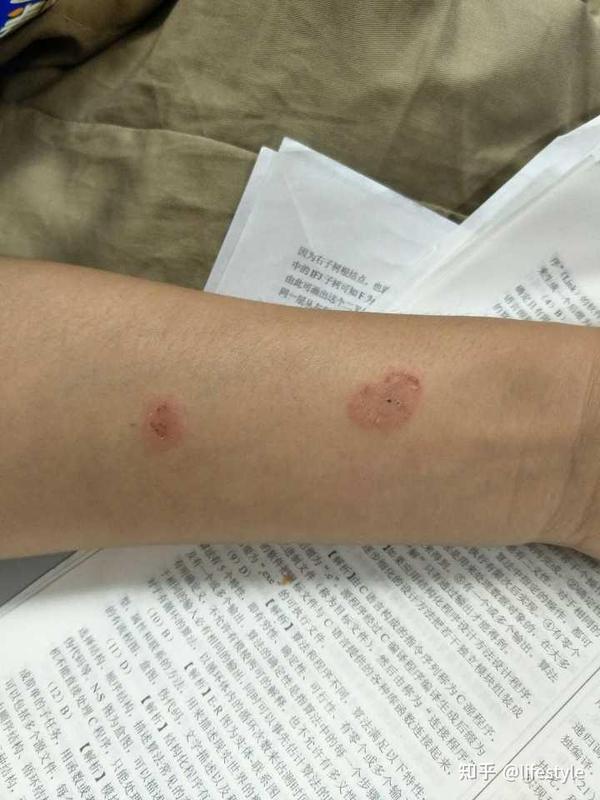 人感染上后,也会出现红色斑块并且