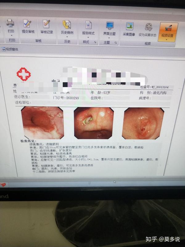 胃溃疡做胃镜,让进一步活检.麻烦问下个各位很严重吗?