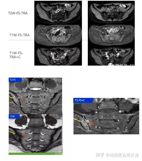 mri:可对骶髂关节炎进行早期诊断,可清晰的显示关节软骨,关节周围的