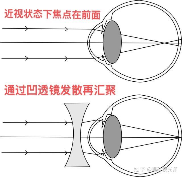 单眼近视戴眼镜时比不戴眼镜时视物更清晰是怎么回事