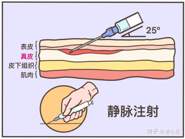 2,静脉注射,斜着扎进血管里