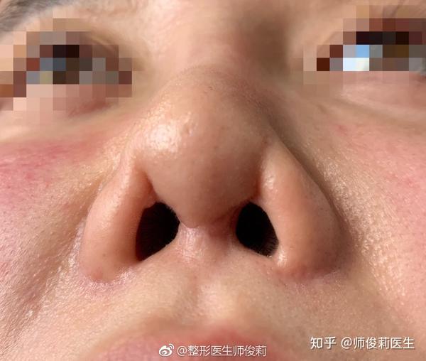 严重鼻畸形案例修复分享