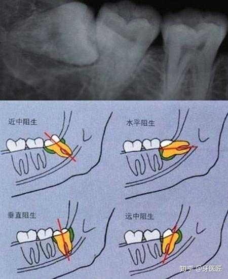 每个人都会长智齿吗? 在临床上看起来,大多数的人应该都有智齿.