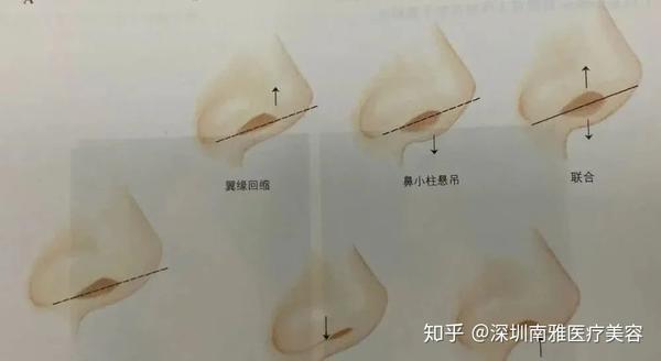 第一种:如果是鼻翼塌陷比较明显,鼻翼缘中重度退缩,鼻翼软骨发育不足