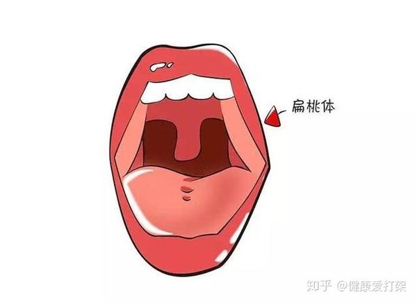 1,成人扁桃体肿大会导致急性面容