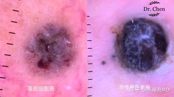 容易与普通痣混淆的恶性病变
