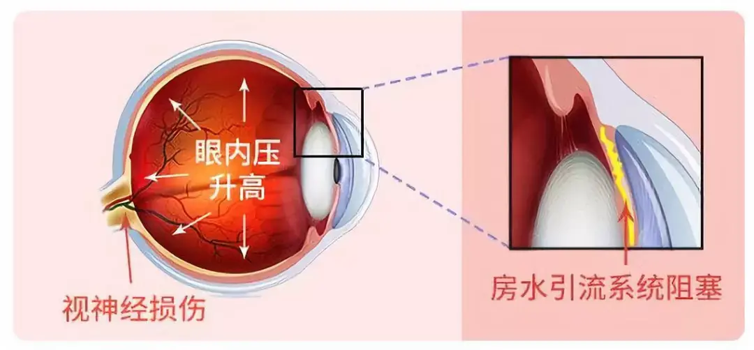 正常状况下,眼睛生产的房水会经过瞳孔由前房排出,但在一些情况下