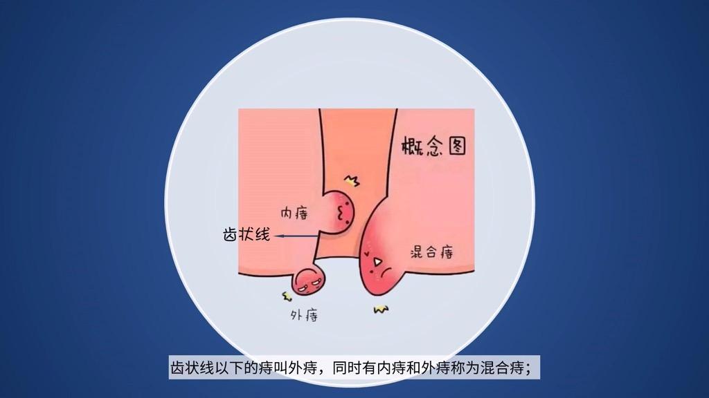 痔仓 知乎