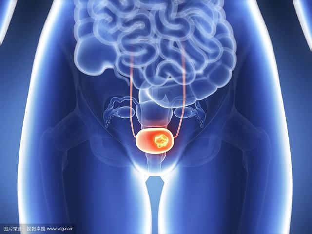 膀胱癌如何早发现?