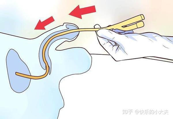 排尿困难怎么办医生提醒7种情况要留尿管4种办法缓解不适感