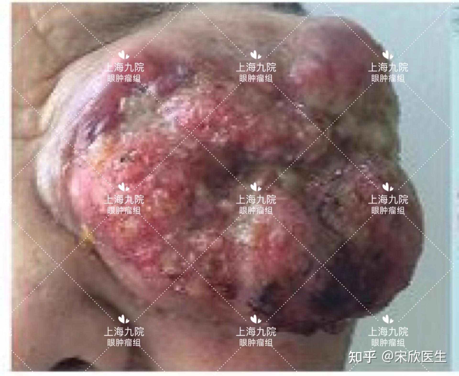 霰粒肿反反复复是何故警惕有可能是皮脂腺癌