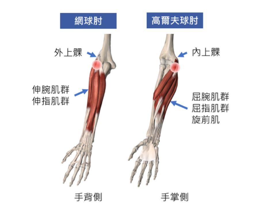 手肘的肌腱伤害在外侧手肘(外上髁)的称为"网球肘";发生在内侧手肘(内