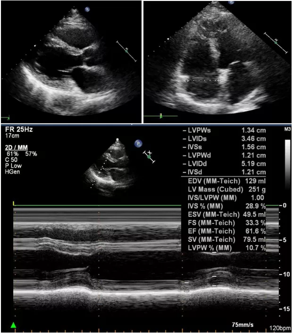 心脏彩超:左房增大,左室肥厚伴舒张功能减退 检查测量值及成人参考值