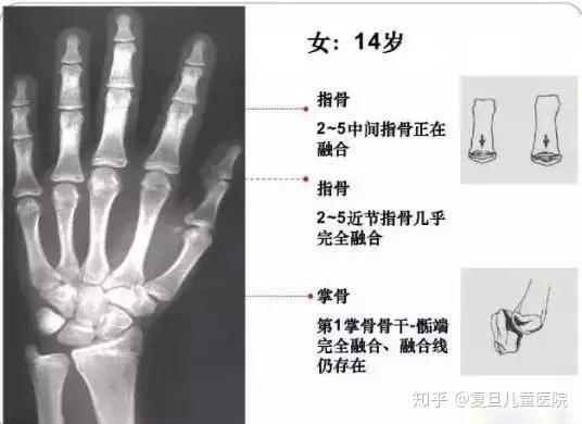 一个是我们普遍用的生活年龄(日历年龄),另一个就是骨龄(生物年