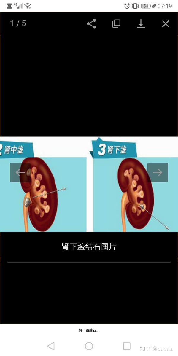 肾下盏结石,一定会将它排出来