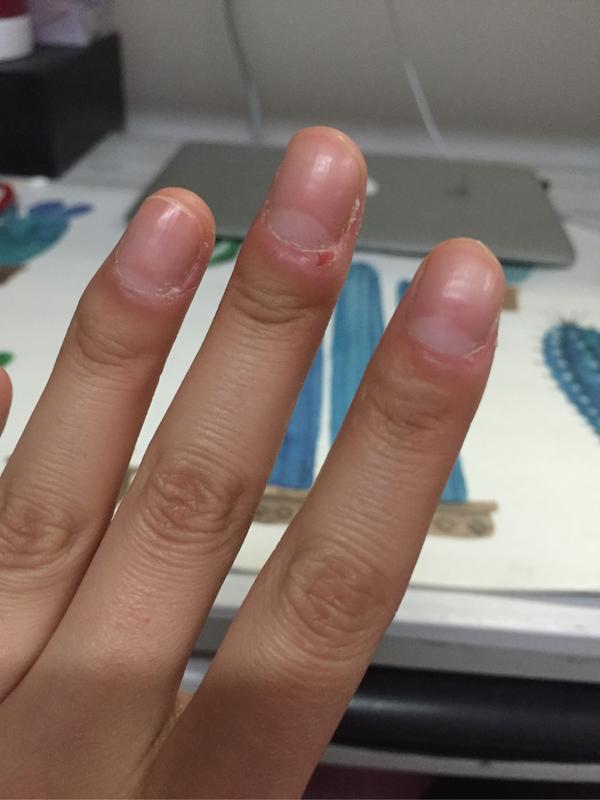 如何控制不自觉的没完没了的撕手皮如何恢复手指皮肤的状态比如已经撕