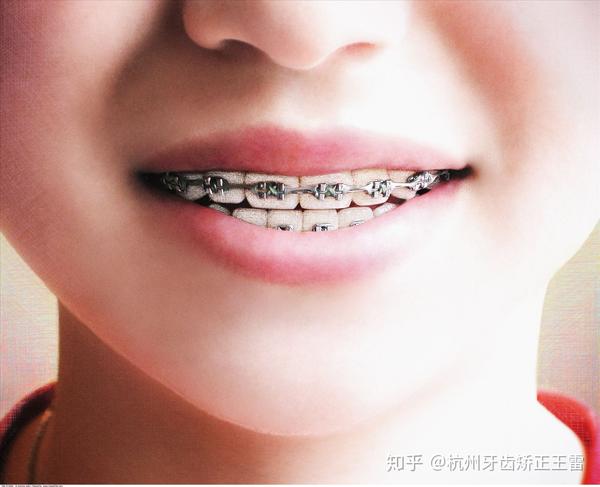 目前最常见的牙齿矫正器种类有: 普通钢丝托槽矫治器,透明陶瓷托槽