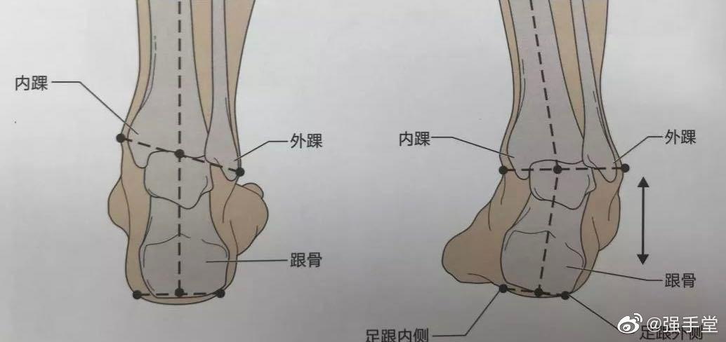 脚扭伤不调理有什么后果