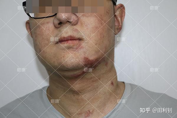 【治疗案例】山西闰先生面部2年烧伤疤痕增生