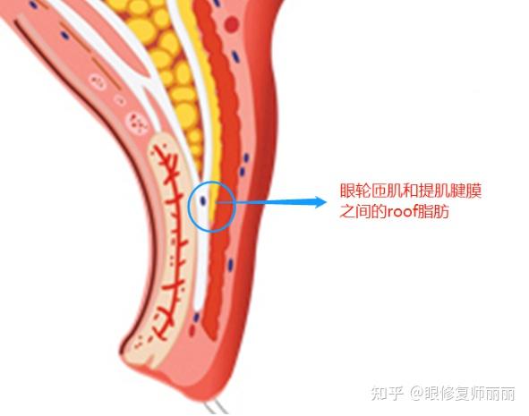 关于roof脂肪的一点想法 我的观点还是 能不去尽量不要去roof脂肪