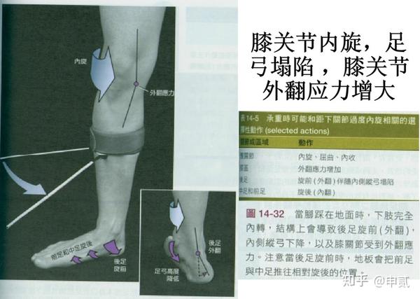 扁平足的康复治疗