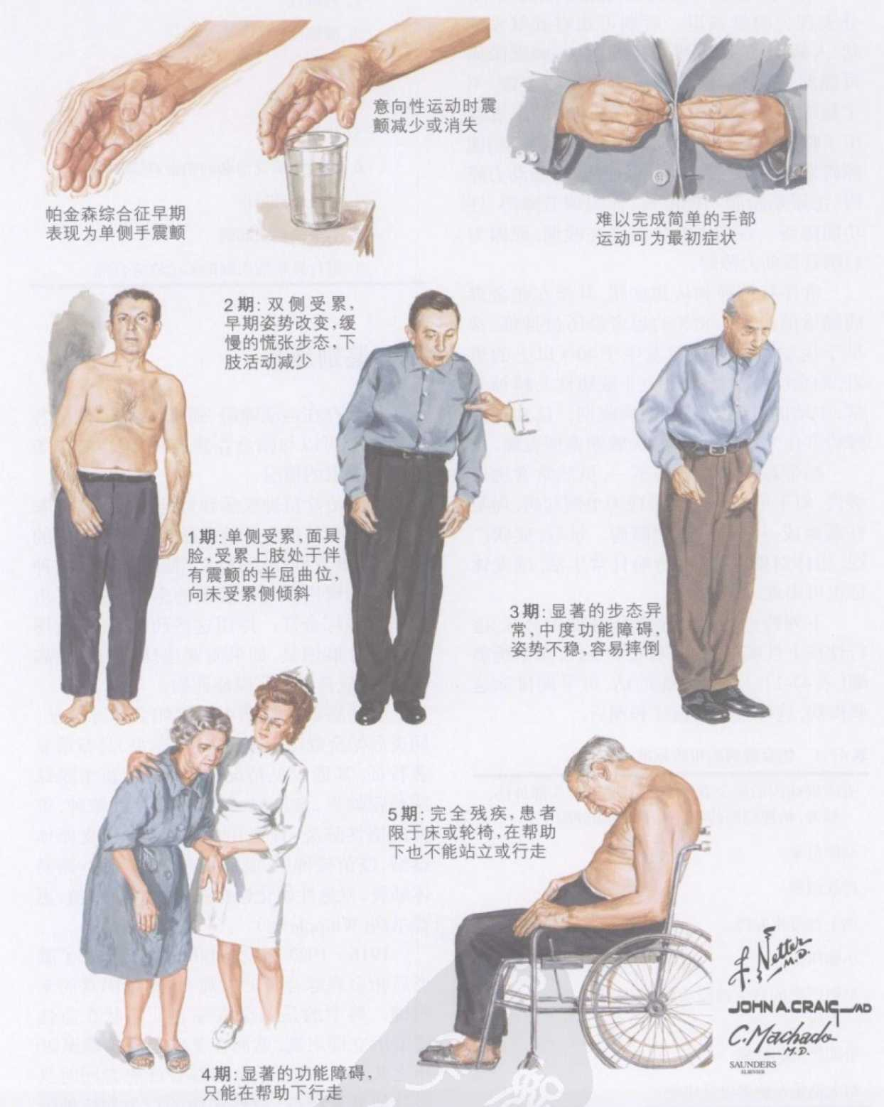 帕金森