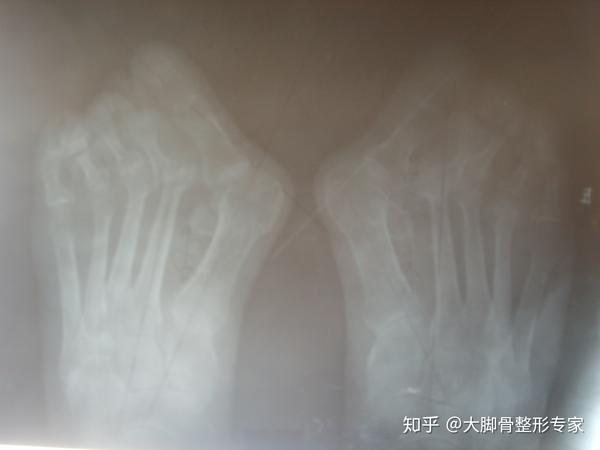 拇外翻x光片